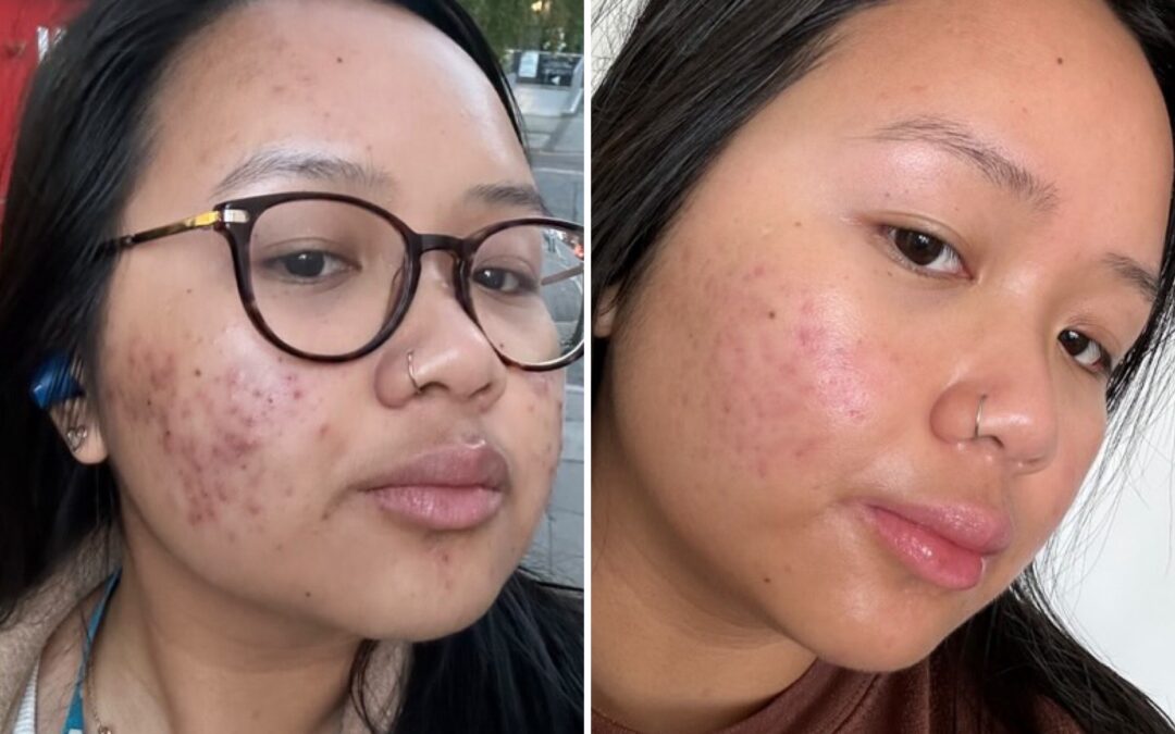 Dealing with acne in your 20s in the social media age