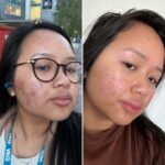 Dealing with acne in your 20s in the social media age