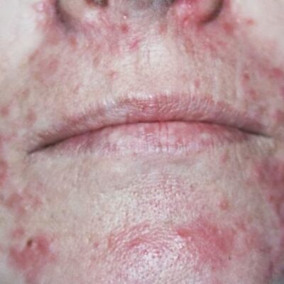 Perioral dermatitis; everything you need to know