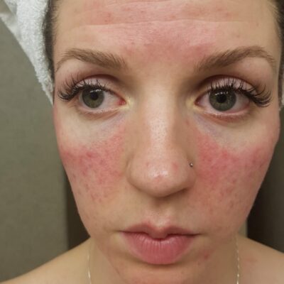 My rosacea healing journey